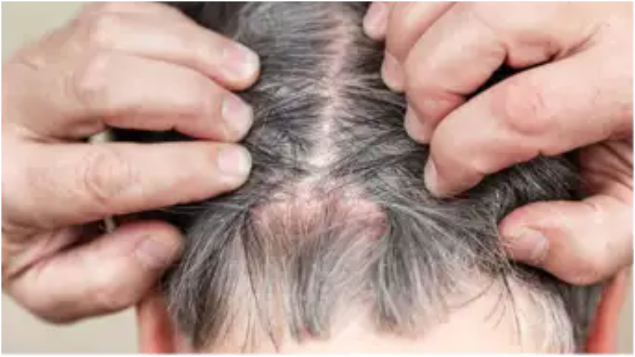 ত্বকের চেয়ে ১২ গুণ দ্রুত বুড়িয়ে যাচ্ছে আপনার মাথার তালু, বুঝবেন যে লক্ষণে